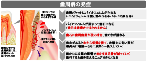 歯周病の発症