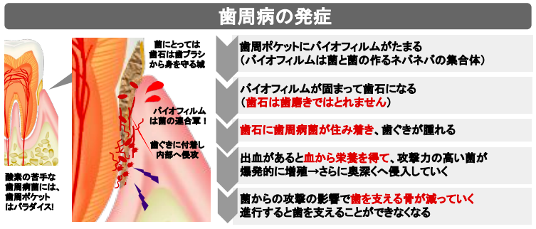 歯周病の発症