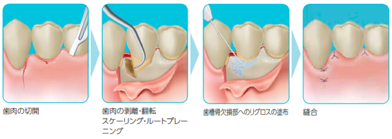 リグロス投与方法