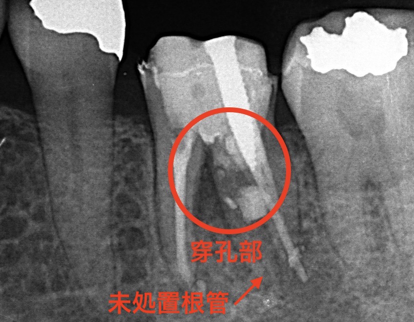 パーフォレーションリペア術前