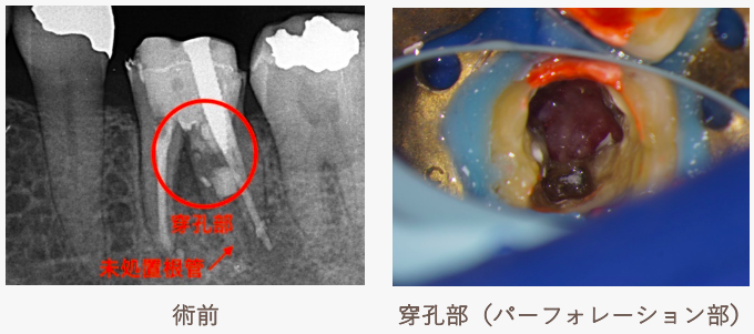 パーフォレーションリペア術前・穿孔部