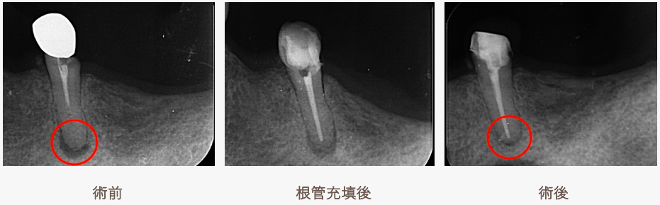 感染根管治療術前・根管充填後・術後