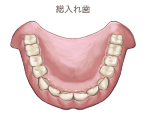 総入れ歯