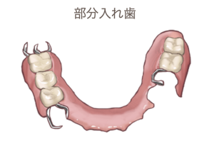 部分入れ歯