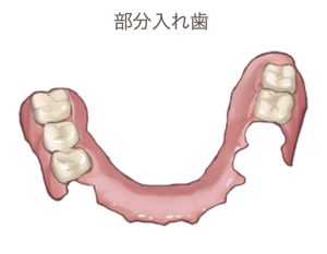 自費部分入れ歯
