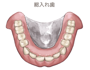自費総入れ歯