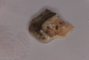 除去した歯石