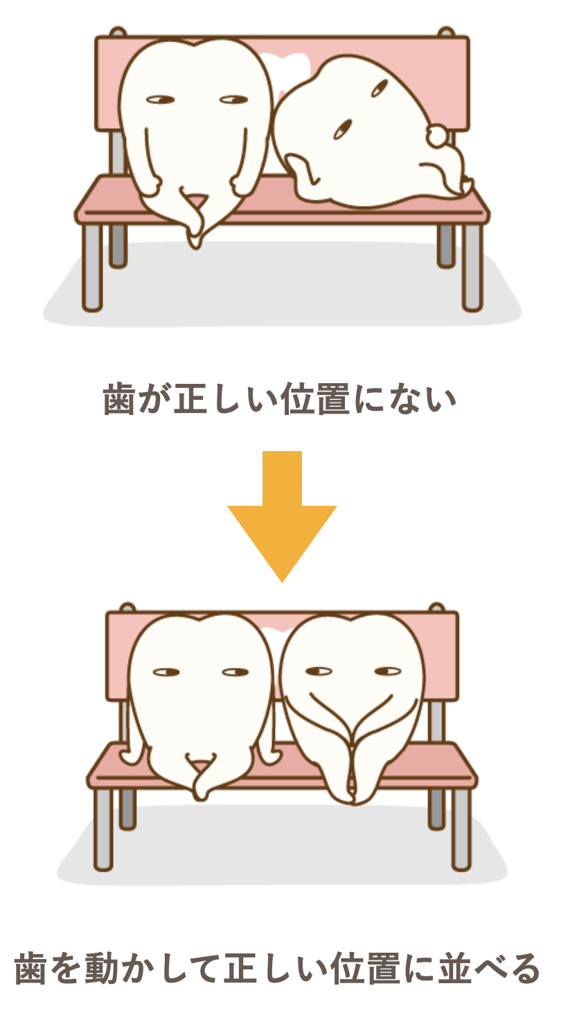 歯が正しい位置にない→歯を動かして正しい位置に並べる