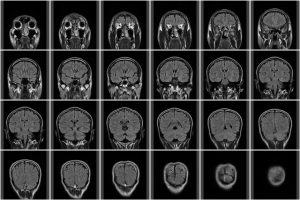 MRI