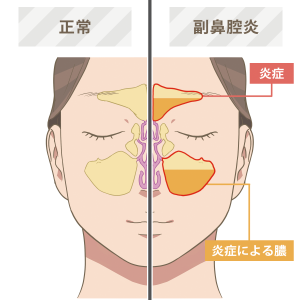 副鼻腔炎