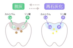 脱灰と再石灰化