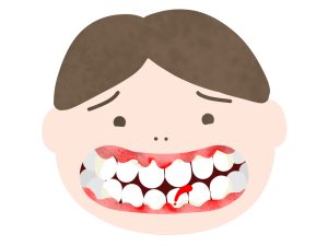 歯ぐき 炎症