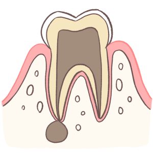根尖性歯周炎