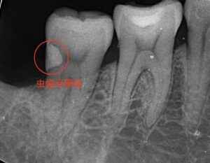親知らずの手前の歯の虫歯治療術後