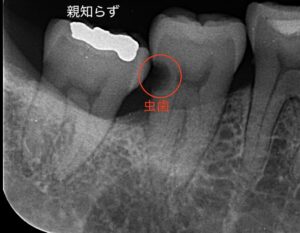 親知らずの手前の歯の虫歯治療術前