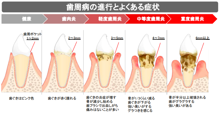 歯周病の進行とよくある症状