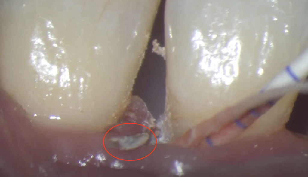 除去した歯ぐきの下の歯石
