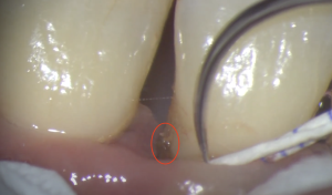 歯ぐきの下の歯石