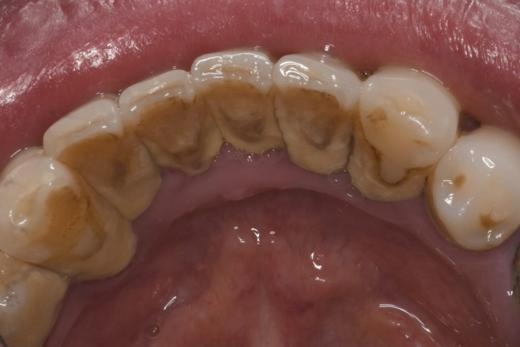 下の前歯の裏側についた歯石