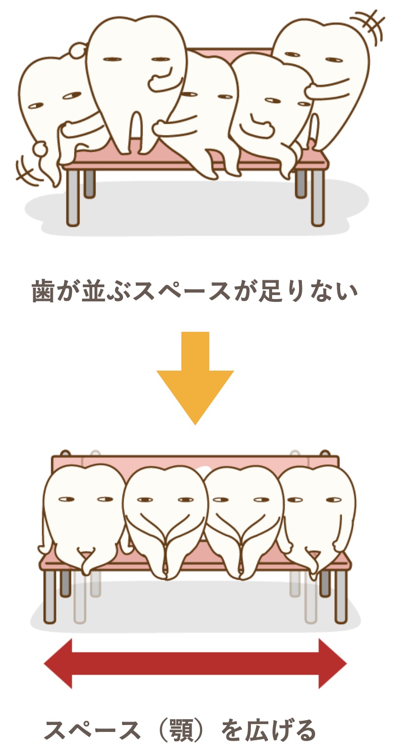 歯が並ぶスペースが足りない→スペース（顎）を広げる