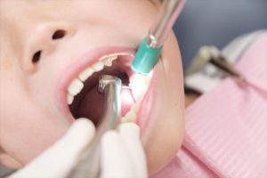 子どもの虫歯治療