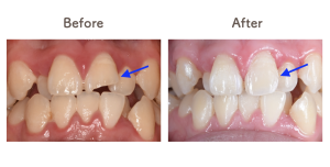 欠けた前歯の修復BeforeAfter