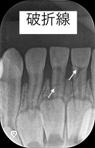 外傷による乳歯の破折