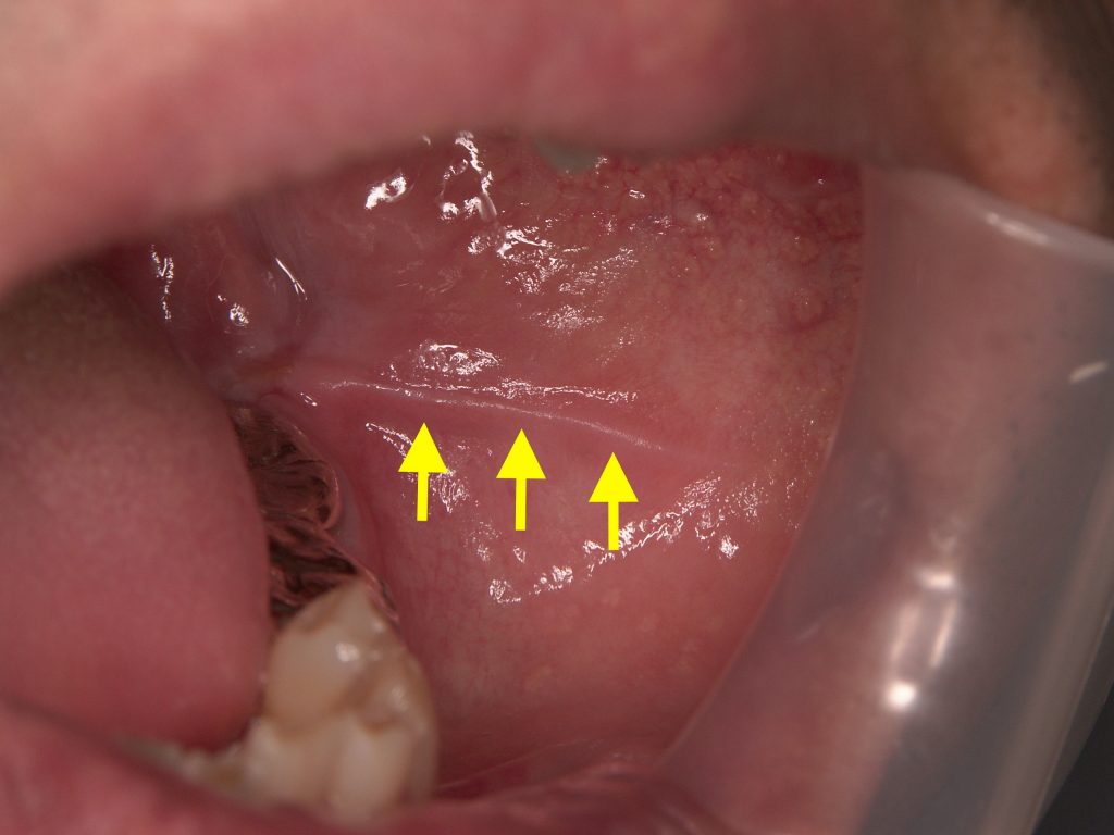 頬粘膜の圧痕