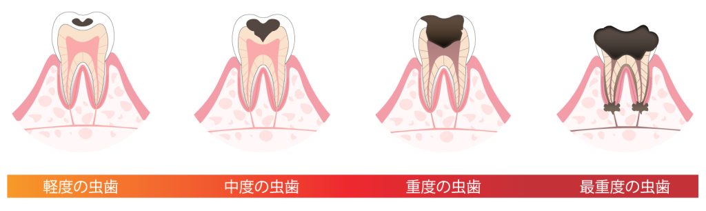 虫歯の進行