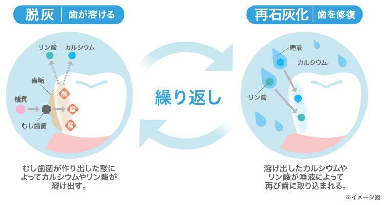 脱灰・再石灰化