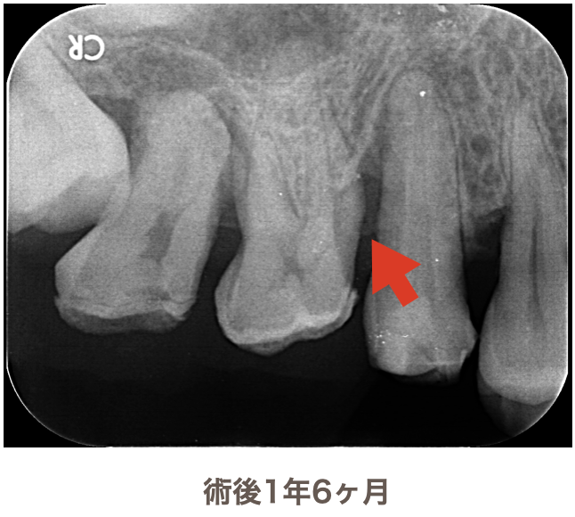 術後1年6ヶ月