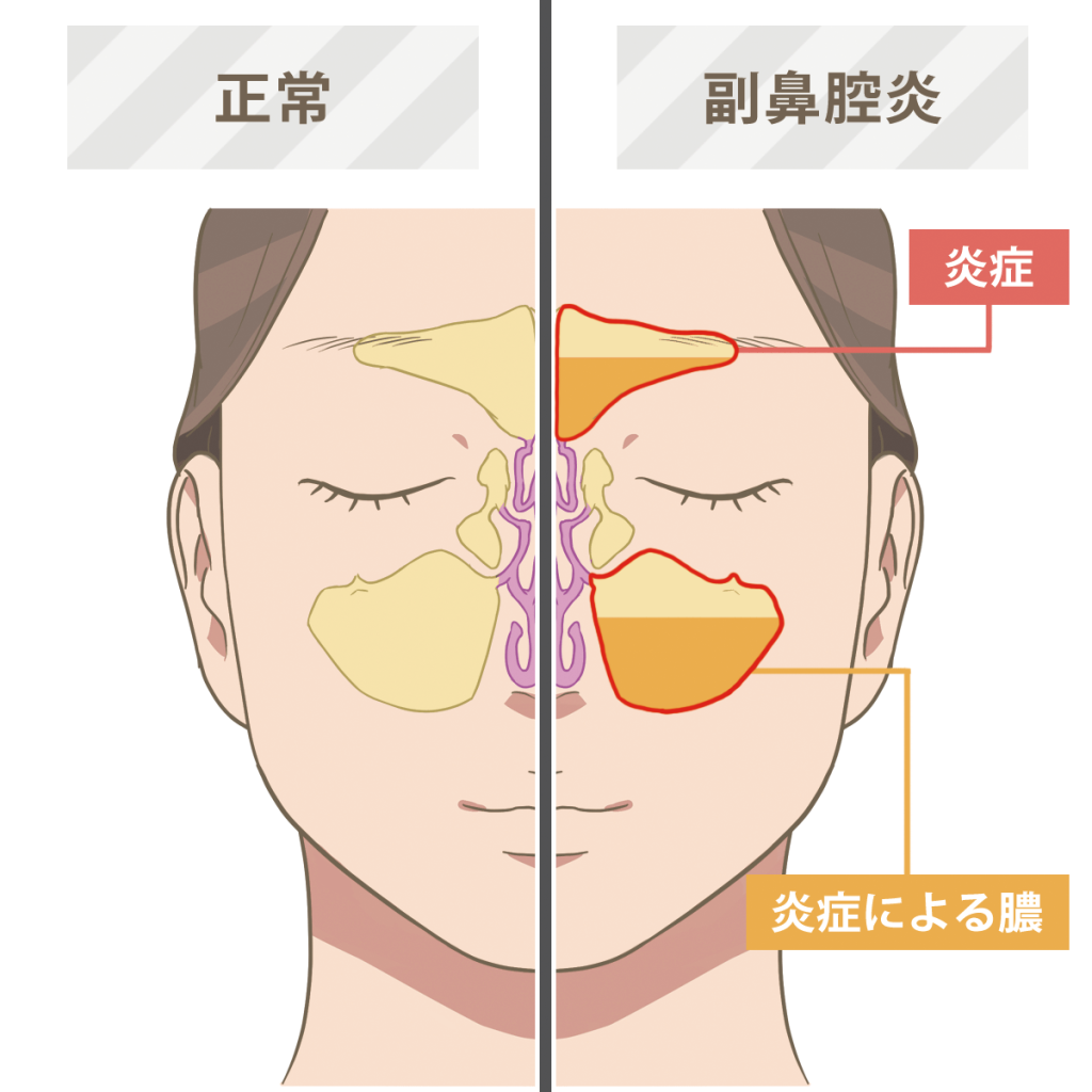 副鼻腔炎