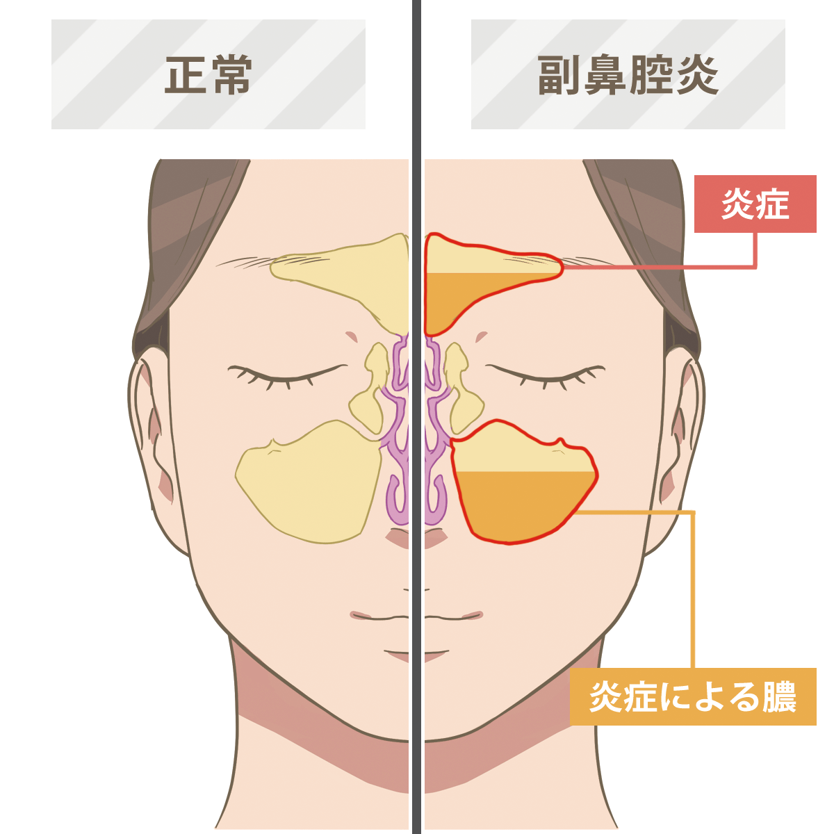 副鼻腔炎