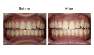 君津市ホワイトニング男性術前・術後