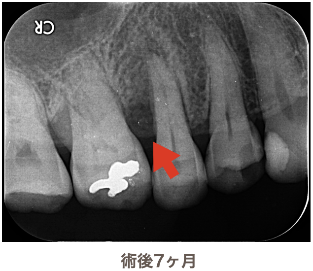 術後7ヶ月