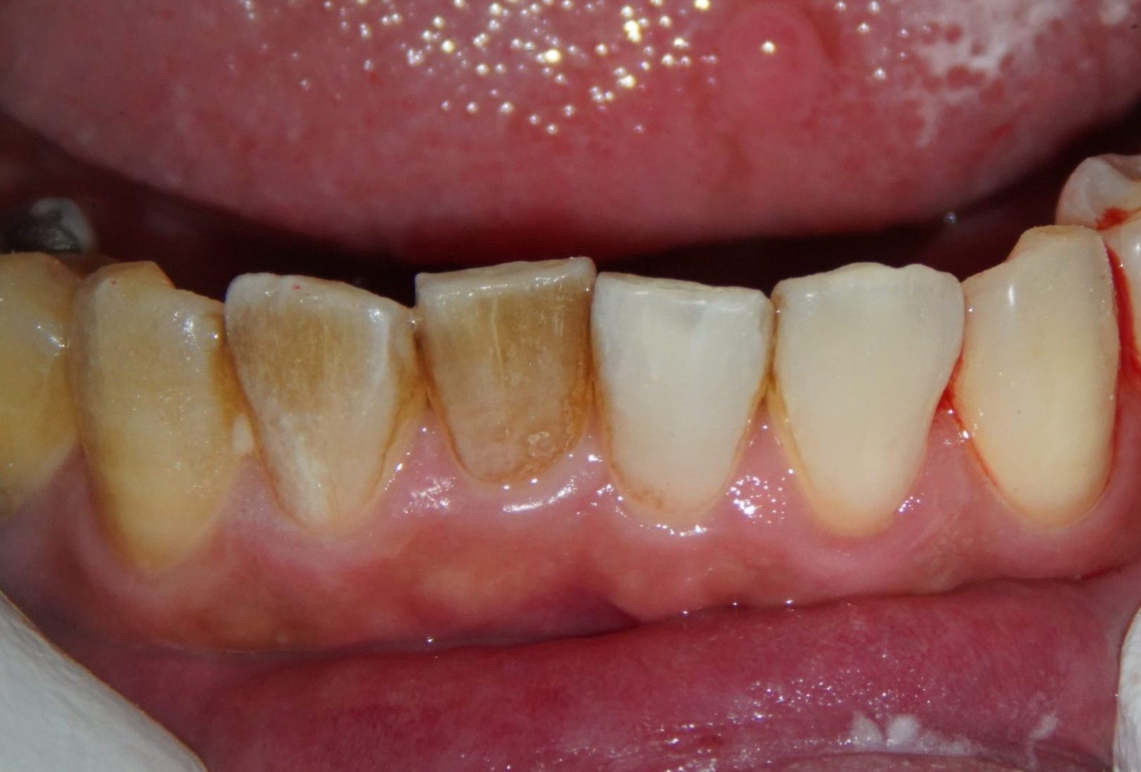 パウダークリーニングの効果