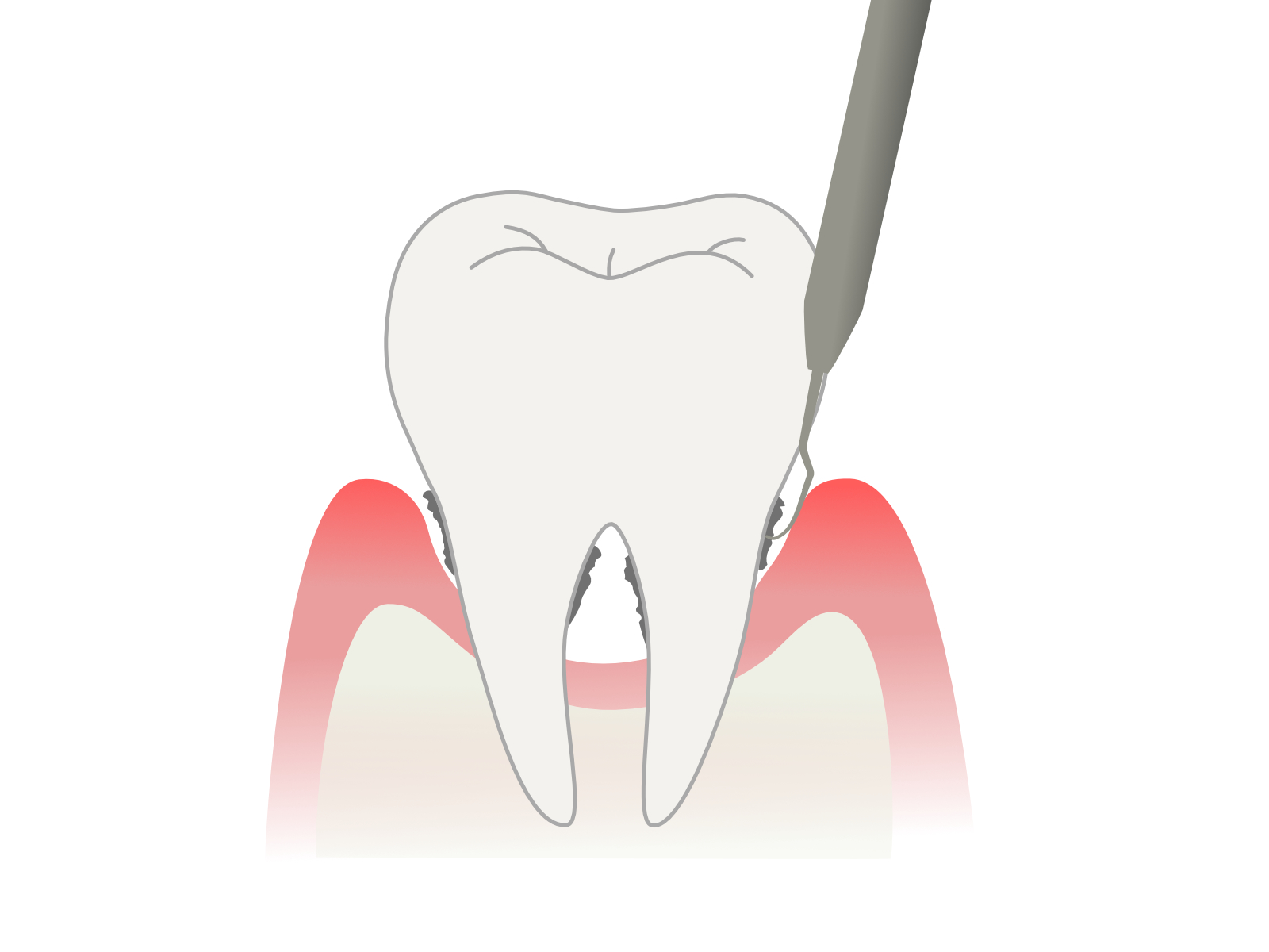 歯周ポケットの検査