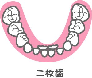 乳歯の後ろから永久歯が生えてくる