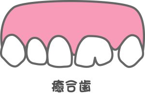 癒合歯