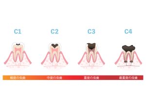 虫歯の進行