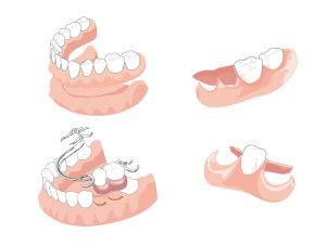 入れ歯の種類
