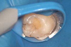 ダイレクトボンデング術前