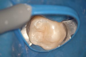 ダイレクトボンデング術後