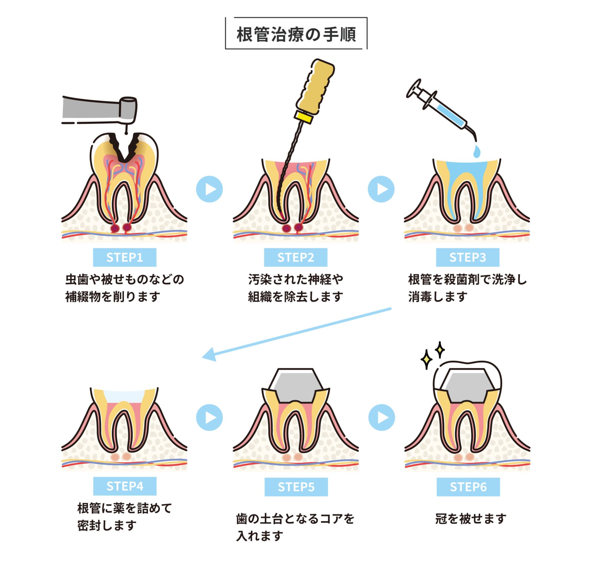 根管治療の手順