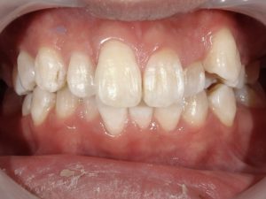 20代男性ホワイトニングAfter