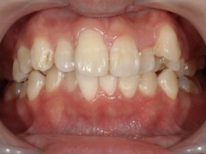 20代男性ホワイトニングBefore