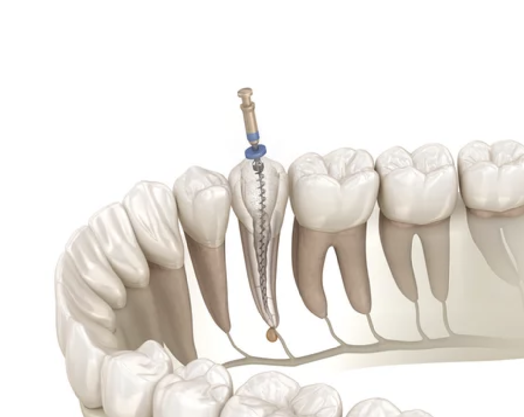 ニッケルチタンファイル