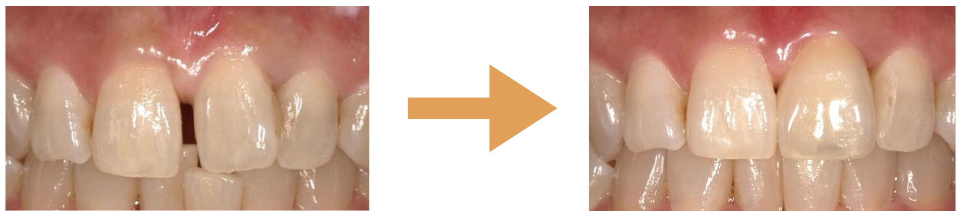 前歯ダイレクトボンディング術前術後