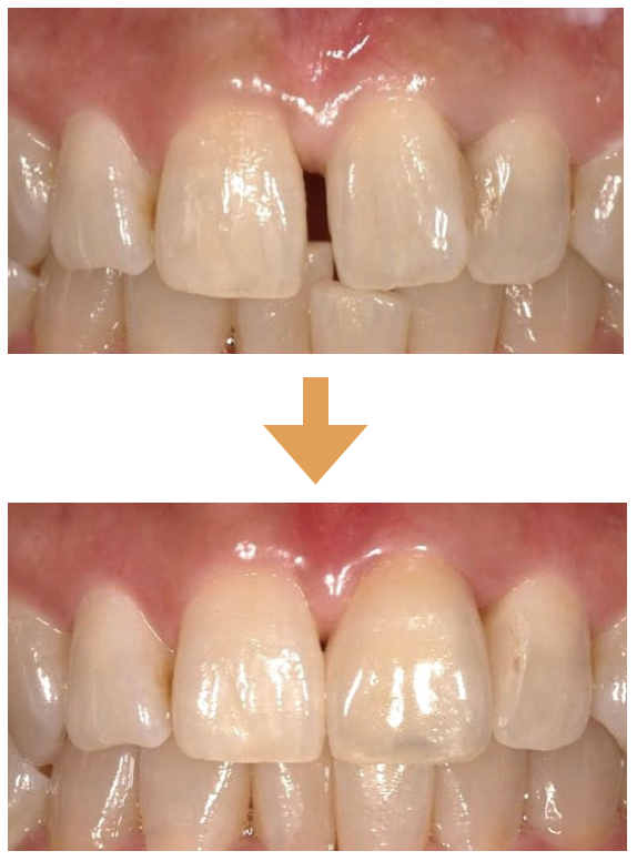 前歯ダイレクトボンディング術前術後
