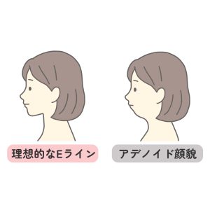 理想的なEラインとアデノイド顔貌